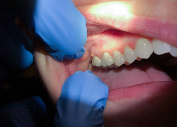 Best Root Canal Emergency Dentist  in Juneau, AK